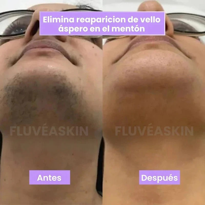 LunéaSkin™ - Vello fino y menos visible con Raiz de Cyperus Rotundus